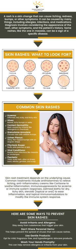 Skin rashes can occur from a variety of factors, including infections, heat, allergens, immune system disorders and medications. Do you have a skin rash and need help treating it? Visit Priority Urgent Care & Walk In Clinic, we specialize in providing the best care for your day-to-day problems. For more information, please contact us or schedule an appointment online. We have convenient locations to serve you in Cromwell, CT, East Haven, CT, Ellington, CT, Newington, CT, Oxford, CT, Unionville, CT and Wallingford, CT.